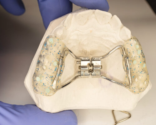 Hyrax,Braces,Wear,On,Patient,Teeth,Gypsum,Model.,Dentist,Check